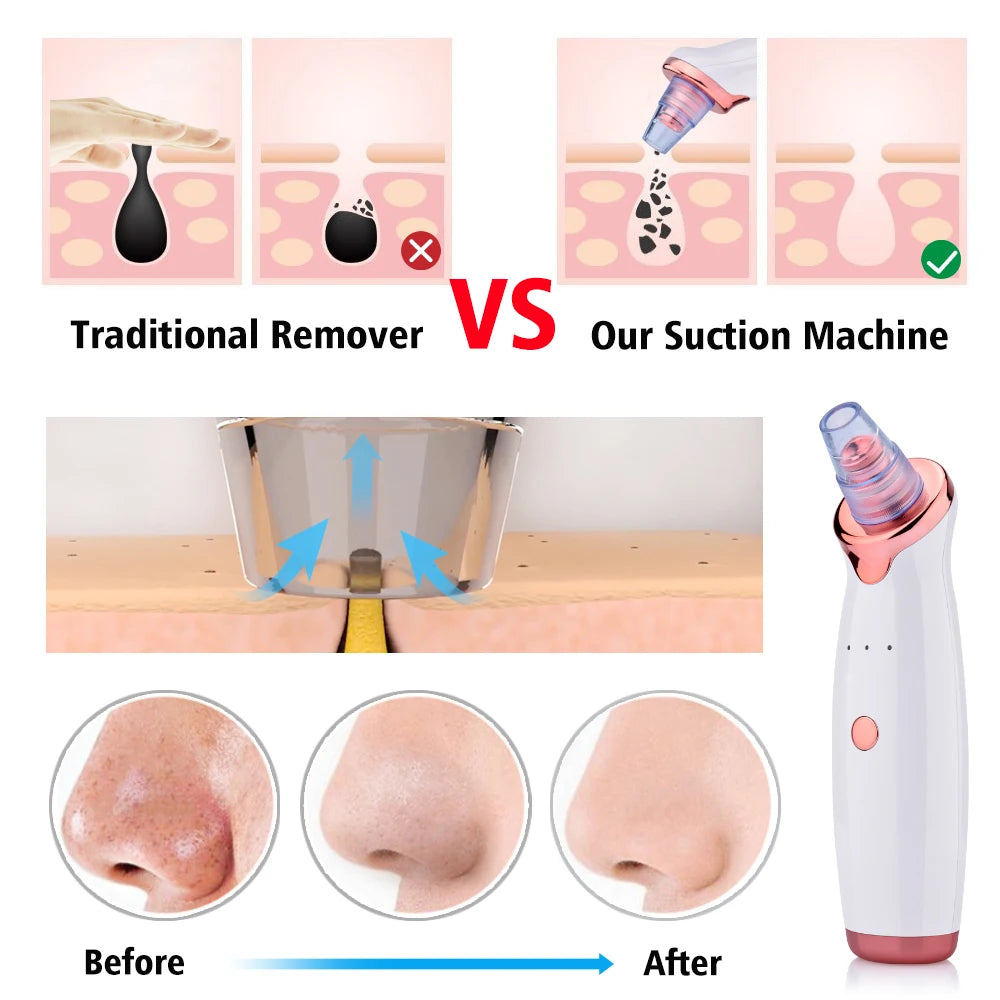 Vacuum Blackhead Removal Facial Cleansing Black Spots Suction Acne Pimple Remover Beauty Instrument USB Charge Skincare Tools - Artigo Importado