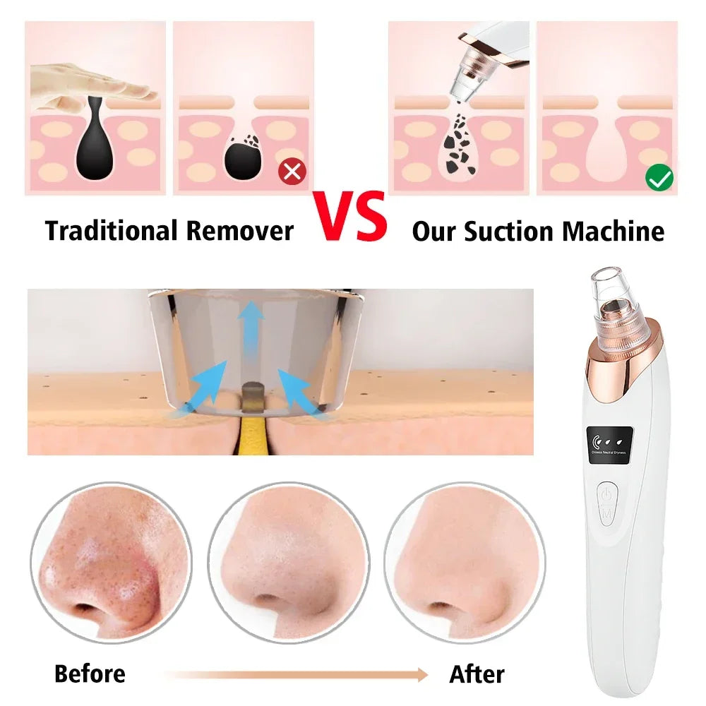 Blackhead Remover Vacuum Suction USB Rechargeable Facial Pore Cleaner Spot Acne Pimple Black Head Deep Extractor Skin Care Kit - Artigo Importado