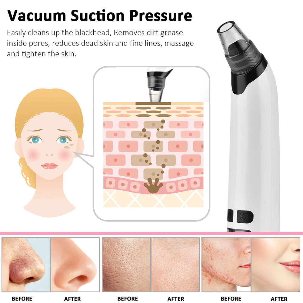 Blackhead Remover Electric Facial Cleansing Pore Vacuum Cleaner Ance Remover Pimple Face Cleaner Skin Scrubber Black Head Vacuum - Artigo Importado