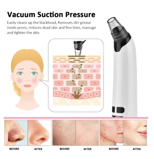 Blackhead Remover Vacuum Suction USB Rechargeable Facial Pore Cleaner Spot Acne Pimple Black Head Deep Extractor Skin Care Kit - Artigo Importado