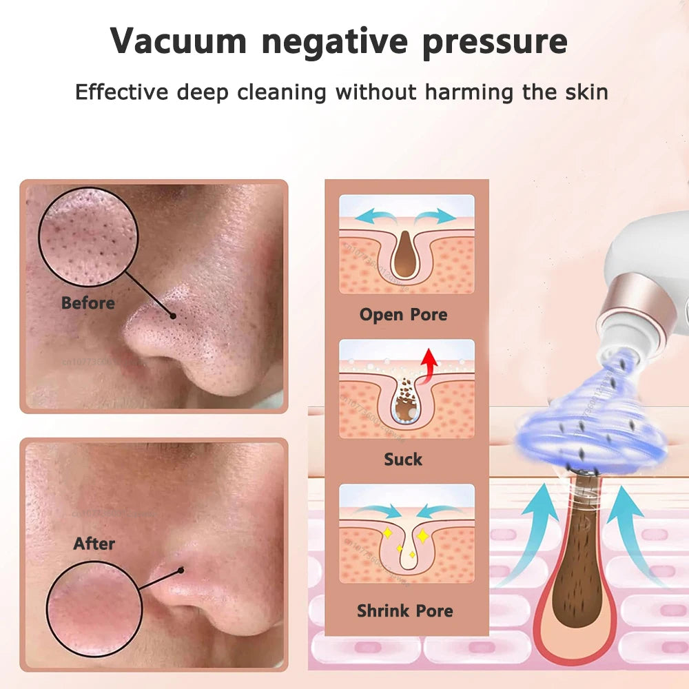 Blackhead Remover Pore Vacuum Face Cleaner Electric Pimple Acne Black Head Removal USB Rechargeable Water Cycle Black Dot Remove - Artigo Importado